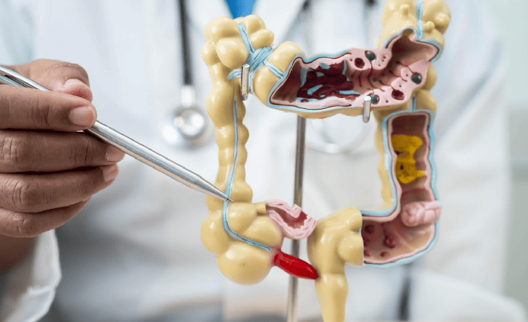 Tratamiento Multidisciplinario para el Cáncer de Colon