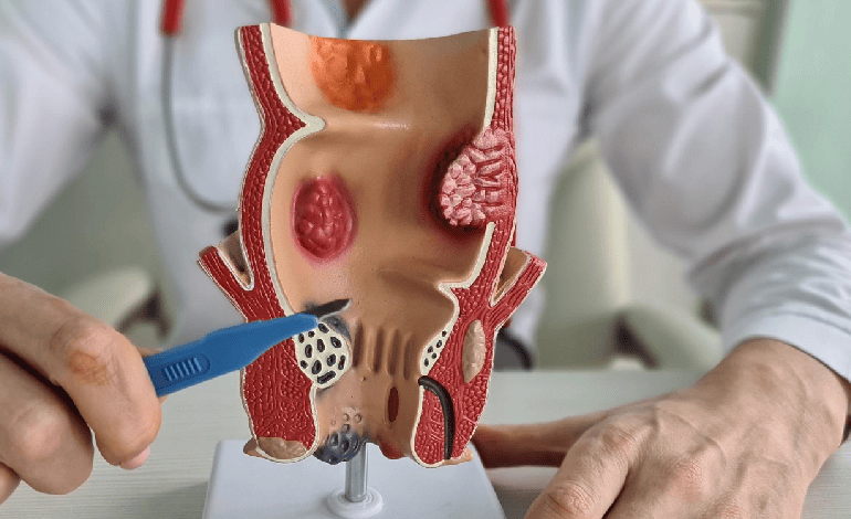 Tratamiento y Cirugía de Hemorroides